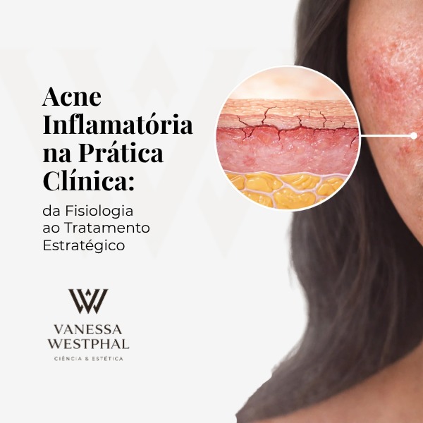 Aula Acne Inflamatória
