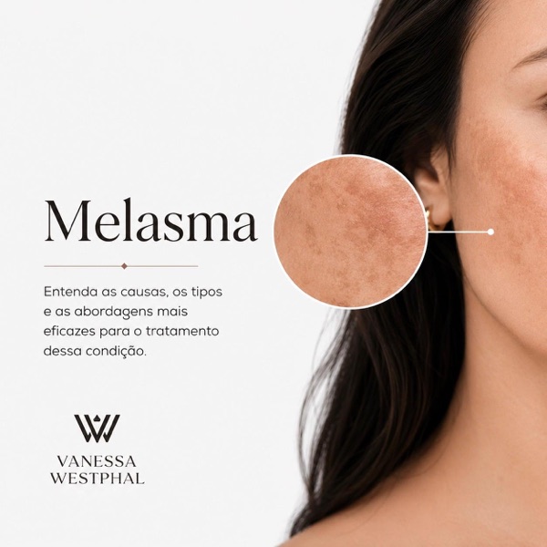 Aula Melasma